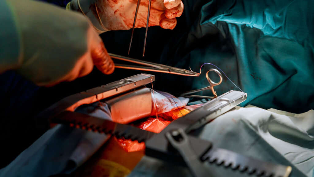 Kardiochirurgia - operacja